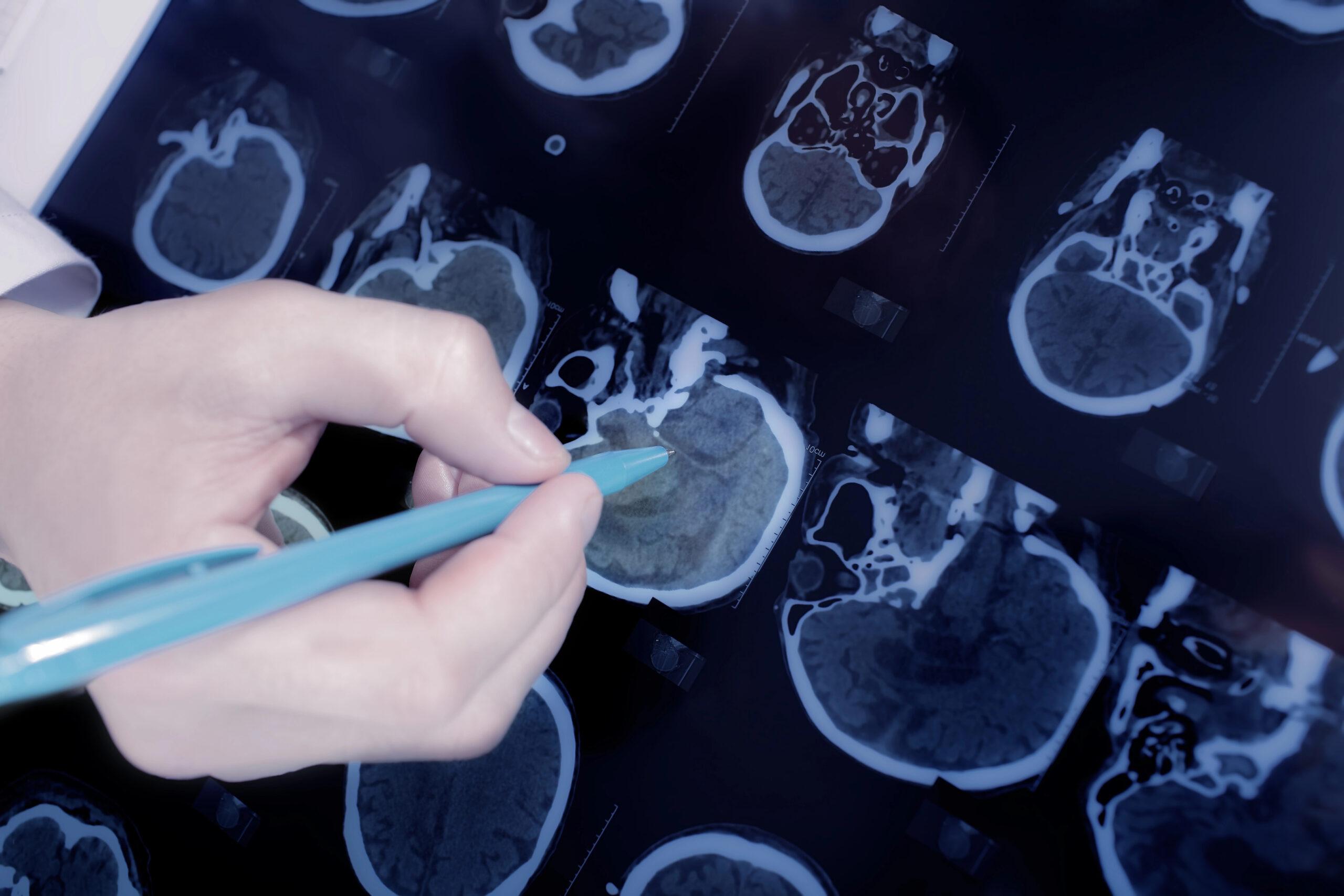 Los pacientes con epilepsia focal tardan más de un año en aliviar los síntomas
